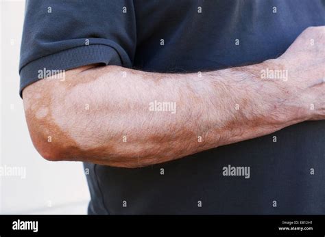 vitiligo fotos|Le vitiligo Banque de photographies et d’images à。